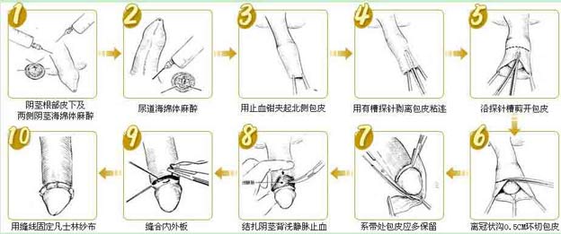 上海九龙医院包皮手术全过程